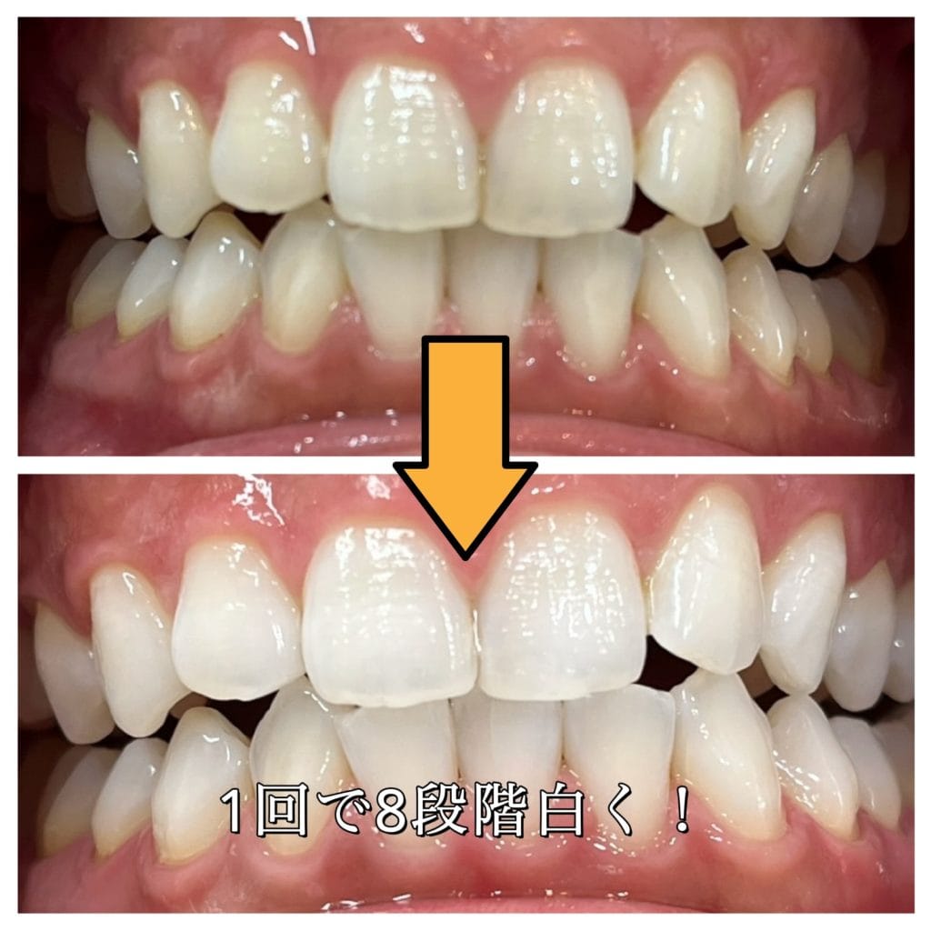 マイスタープラスホワイトニングを受けた患者のビフォーアフター