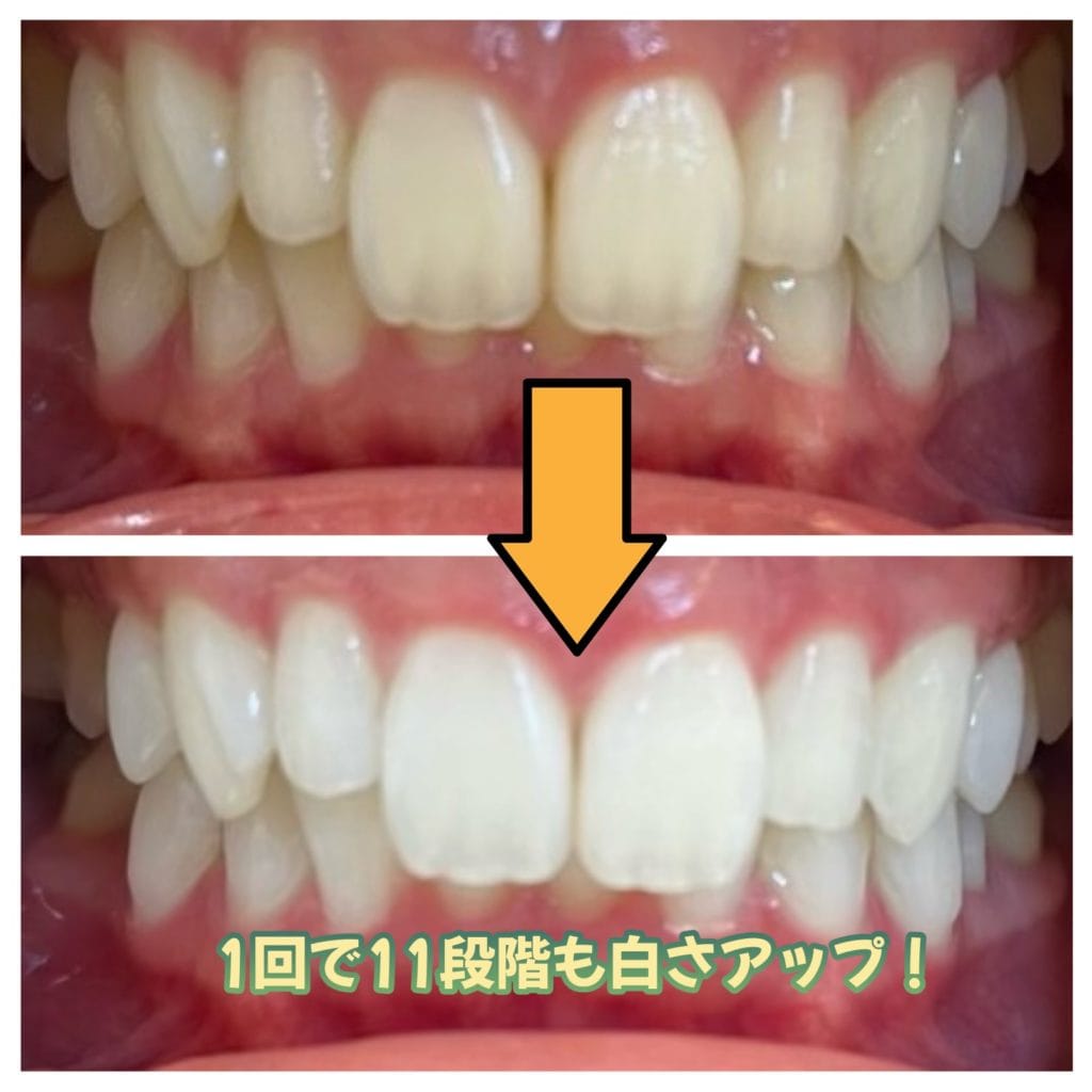 マイスタープラスホワイトニングを受けた患者のビフォーアフター