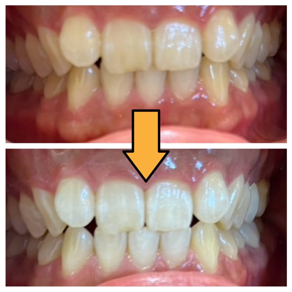 マイスタープラスホワイトニングを受けた患者のビフォーアフター