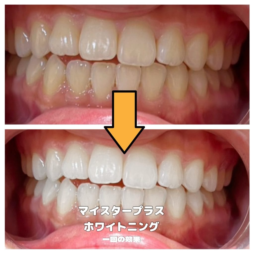 マイスタープラスホワイトニングを受けた患者のビフォーアフター
