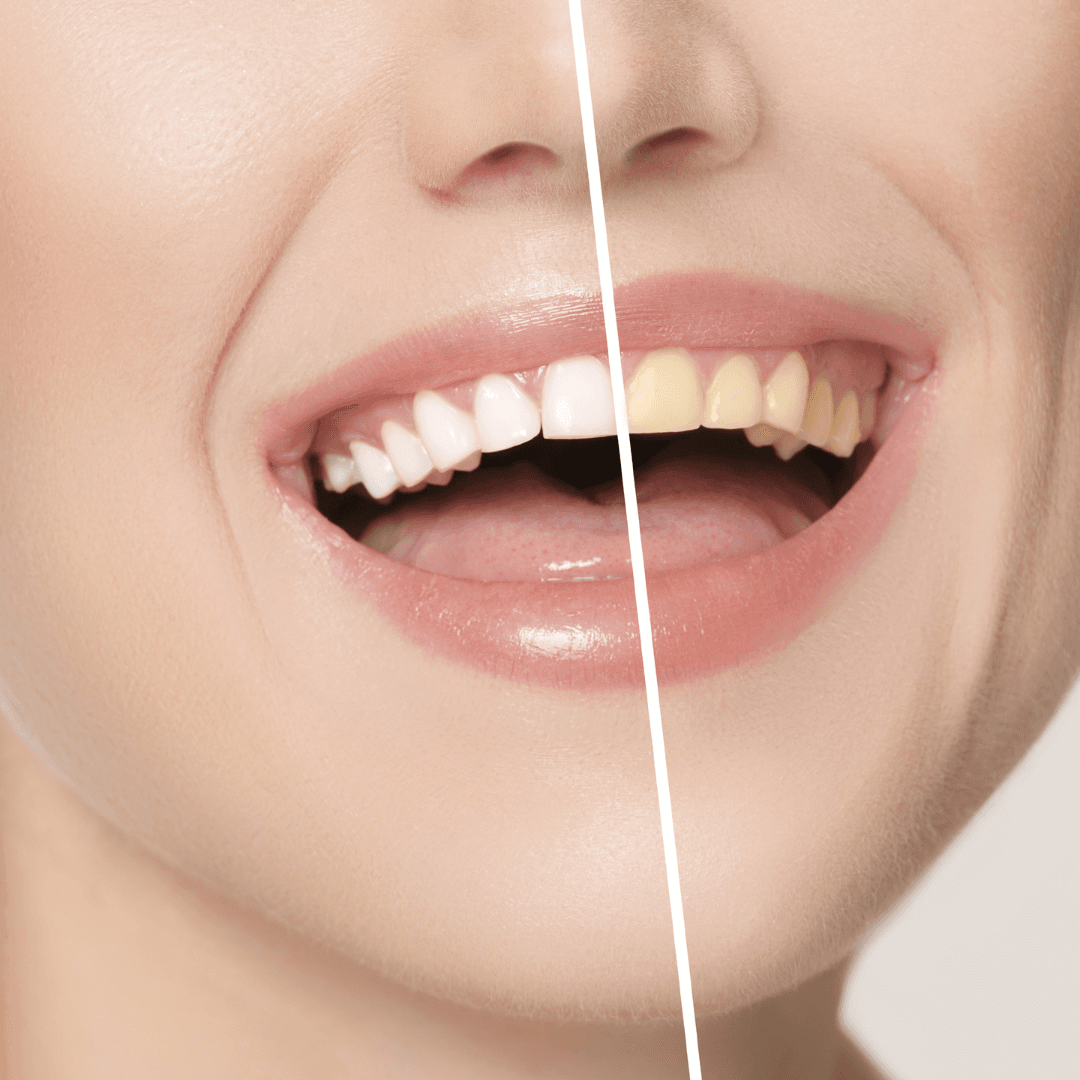 ホワイトニングによる印象の違いビフォーアフター